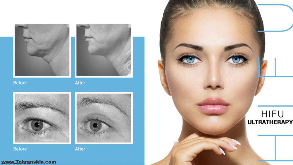 هایفوتراپی