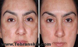 درمان قطعی لک صورت با مزوتراپی لک صورت melasma treatment2 300x180 - درمان قطعی لک صورت با مزوتراپی لک صورت