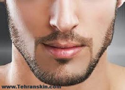 بهترین دستگاه لیزر بدون عوارض لیزر صورت مردان