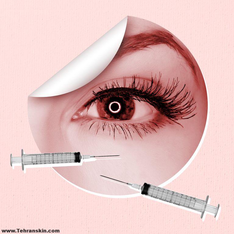 دکتر خوب برای تزریق فیلر زیر چشم