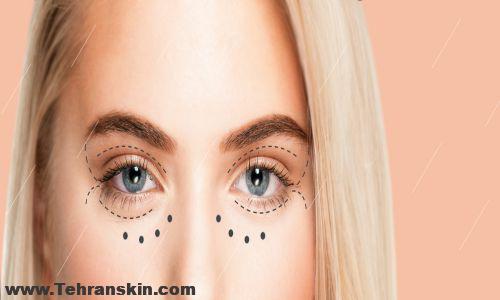 هزینه لیفت پلک