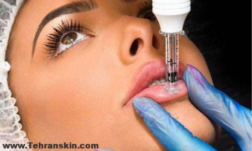 هزینه تزریق ژل لب