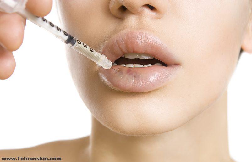 از بین بردن ورم صورت بعد از تزریق ژل