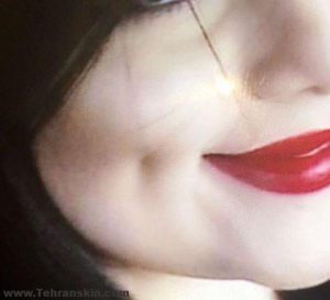 بهترین روش ایجاد چال گونه