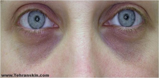 عوارض تزریق چربی زیر چشم