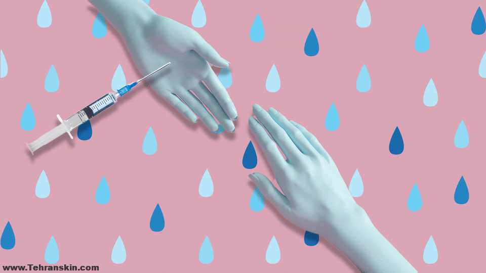 بوتاکس کف دست