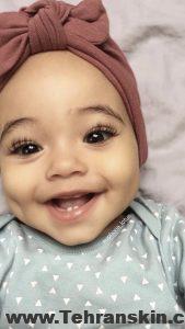 بهترین کلینیک زیبایی چال گونه در تهران