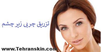 هزینه تزریق چربی زیر چشم