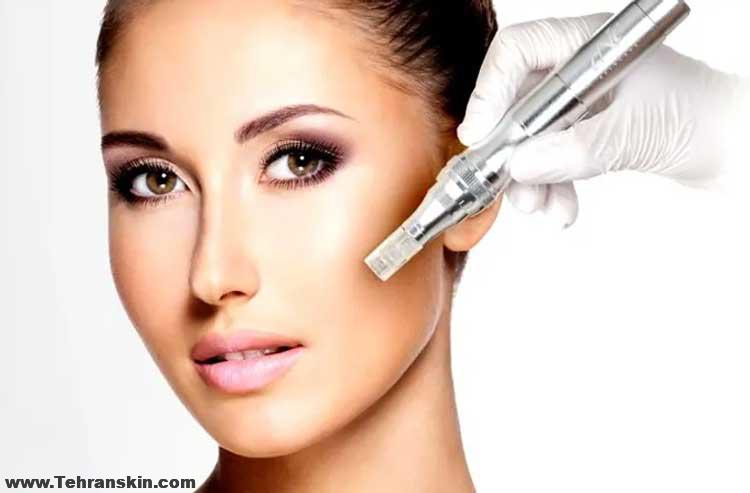 میکرونیدلینگ خانگی