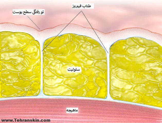 درمان قطعی سلولیت