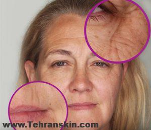 bear skin types 1 300x258 - رفع چین و چروک صورت با بوتاکس | هزینه بوتاکس صورت