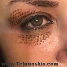 %D9%BE%D9%84%D8%A7%D8%B3%D9%85%D8%A7 2 - 8 نکته بی پرده درباره بهترین تخفیف پلاسما جت بینی و بلفاروپلاستی