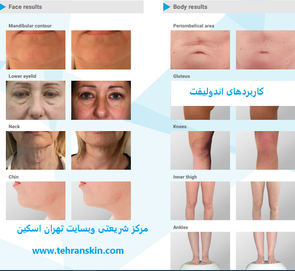 endolift uses for face and body - از صفر تا صد اندولیفت صورت: بهترین متخصص اندولیفت تهران+فیلم، عکس
