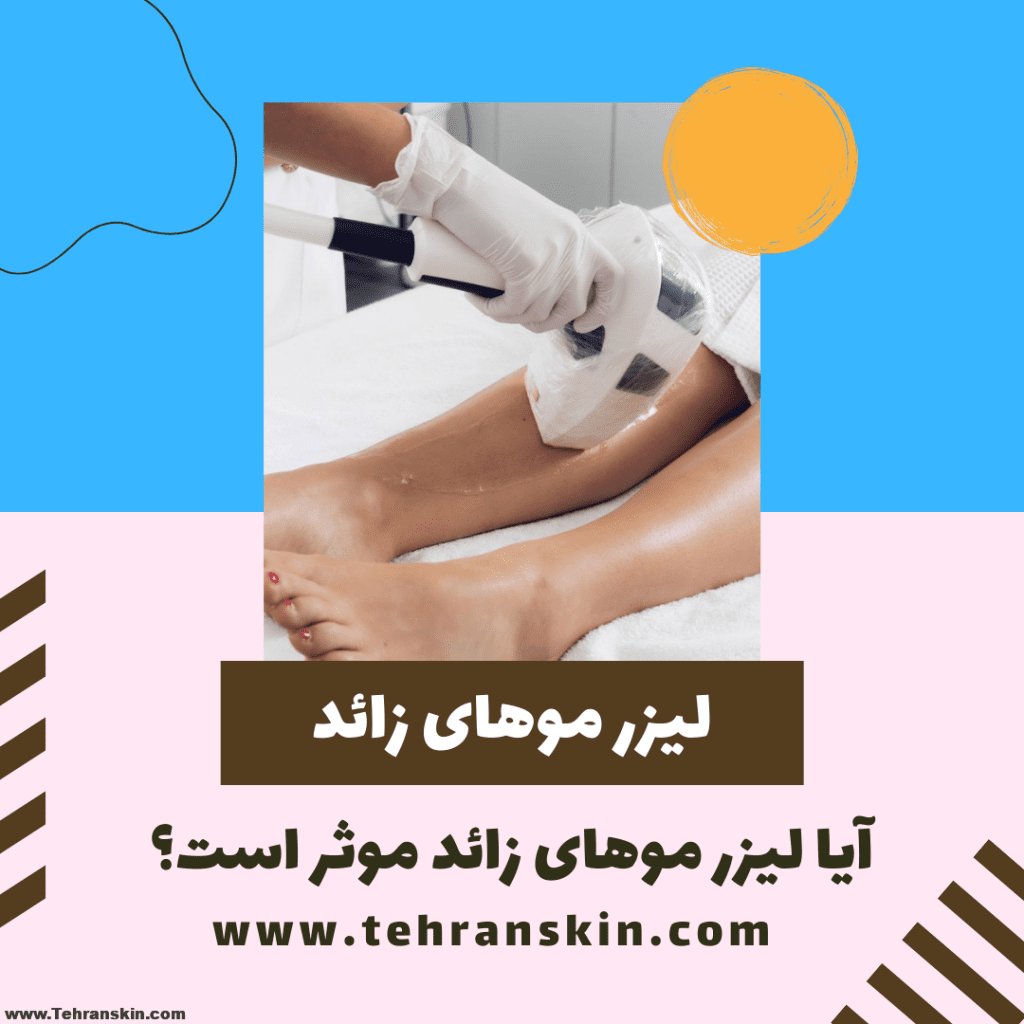 لیزر موهای زائد چقدر موثر است