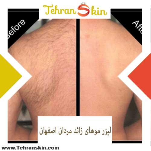 لیزر موهای زائد مردان اصفهان