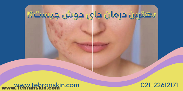 بهترین درمان برای جای جوش فرورفته