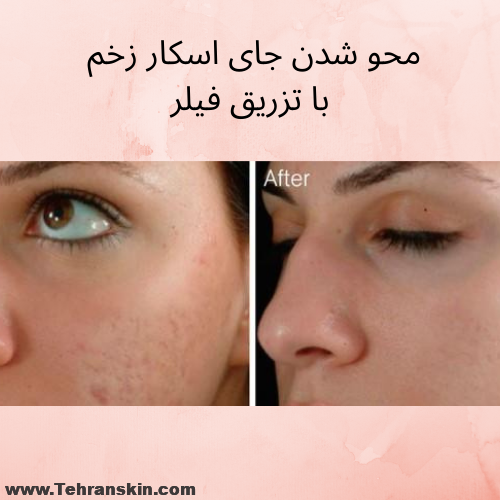محو شدن جای زخم اسکار ژل محو شدن جای زخم اسکار ژل