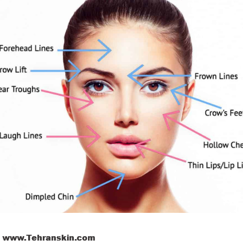 تفاوت ژل بوتاکس فرق بوتاکس و ژل فیلر